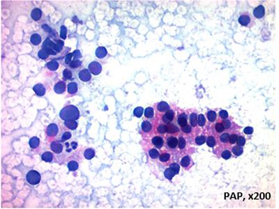 Editorial: Subclassification of AUS/FLUS category for thyroid nodules: trials and evidence-based clinical management